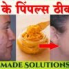 चेहरे से पिंपल कैसे हटाए घरेलू उपाय CHEHRE KE PIMPLE KAISE HATAYE GHARELU UPAY